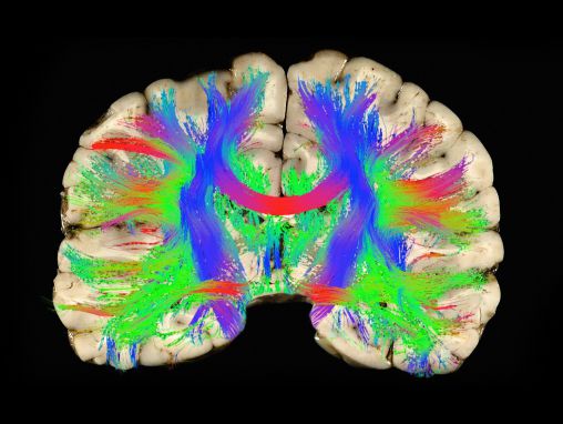 Click to play David Camarillo: Why helmets don't prevent concussions -- and what might